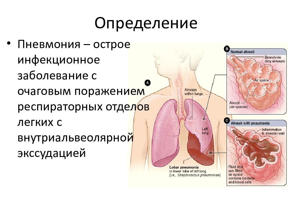 Пневмония это презентация