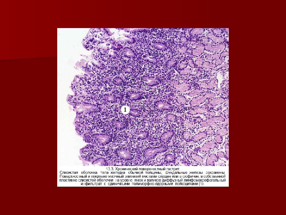 Хроническая язва желудка микропрепарат рисунок