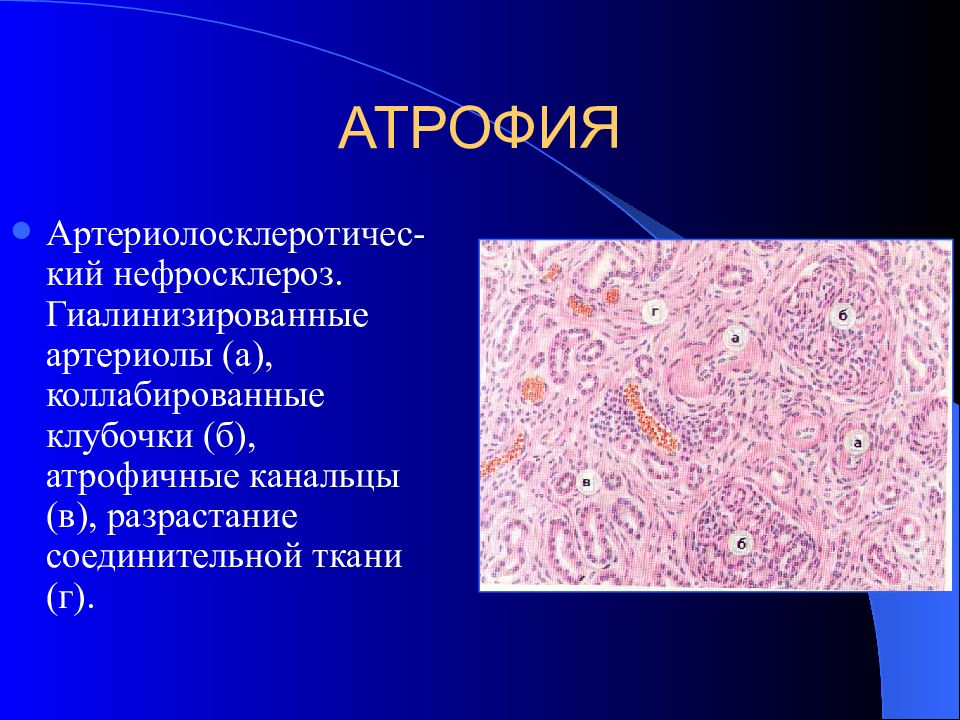 Разрастание ткани. Атрофия соединительной ткани. Разросшаяся соединительная ткань. Гиалинизированная соединительная ткань. Атрофия канальцев почки.