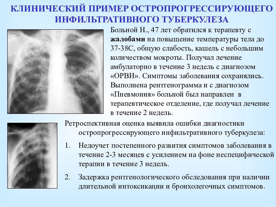 Врожденный туберкулез презентация