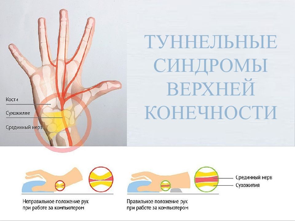 Туннельные синдромы верхней конечности