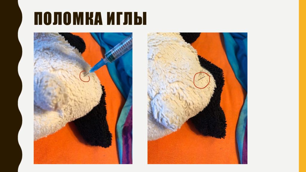 Постинъекционные осложнения поломка иглы. Поломка инъекционной иглы. Поломка иглы причины. Осложнения при поломке иглы. Поломка иглы при инъекции.