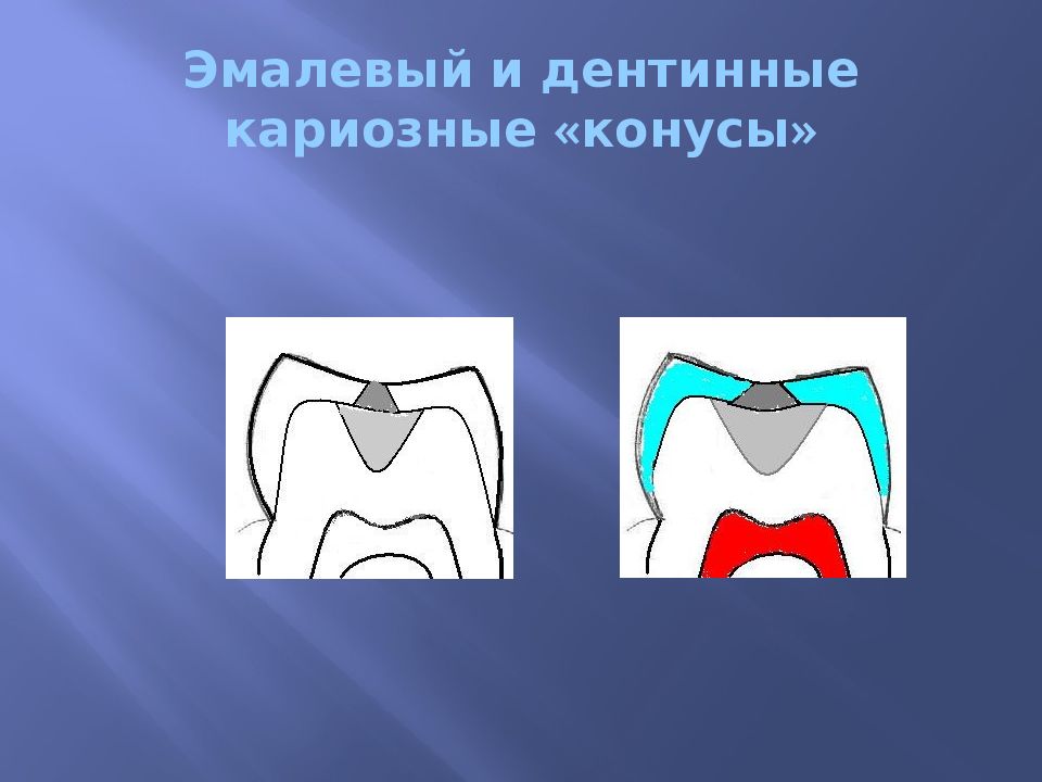 Кариозная полость сообщается с полостью зуба. Эмалево дентинная граница. Базисная дентинная и эмалевая масса. Целостность эмалево-дентинного соединения при среднем кариесе. Целостность эмалево дентинного соединения не повреждена при.