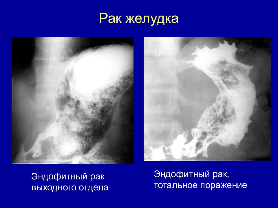 Эндофитный рост опухоли рисунок