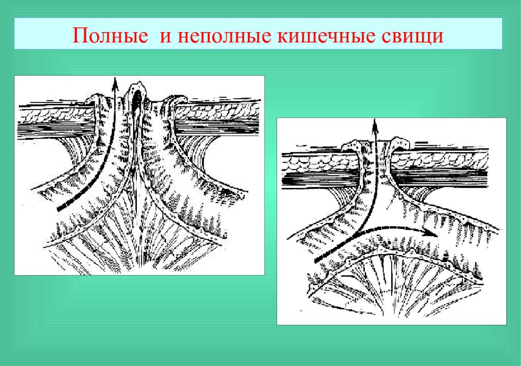 Профилактика свищей. Неполный губовидный свищ. Губовидный кишечный свищ. Кишечные свищи губовидные и трубчатые. Неполный кишечный свищ.