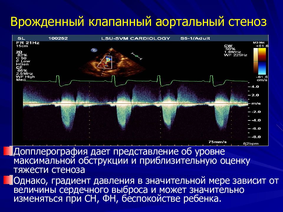 ЭХОКГ измерение градиента давления на аортальном клапане. Аортальный стеноз допплерография. Эхокардиограмма при аортальном стенозе. Аортальный клапан градиент давления при стенозе.