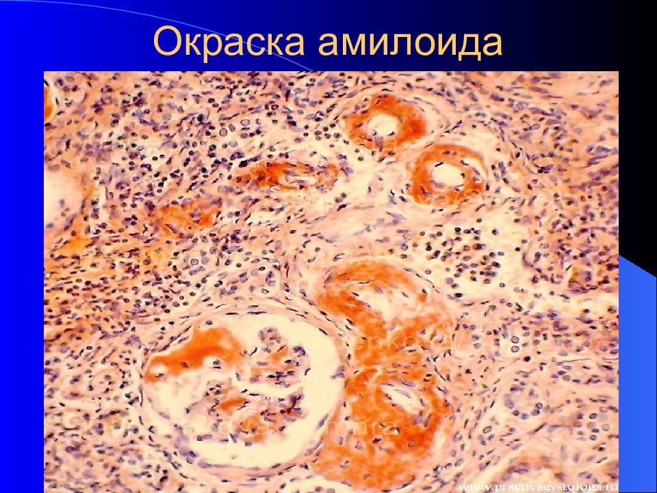 Амилоидоз печени конго красный. Амилоидоз печени конго красный. Амилоидоз почек окраска конго красный. Амилоидоз печени микропрепарат конго красный. Амилоидоз почки микропрепарат конго красный.