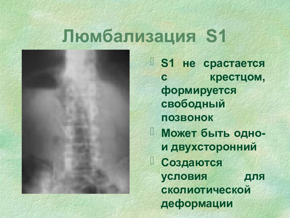 Сросшиеся крестец. Люмбализация s1 позвонка рентген. Люмбализация l5 позвонка рентген. Люмбализация s1 позвонка мрт. Переходный позвонок люмбализация s1.