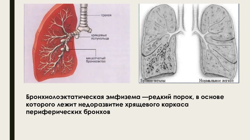 Пороки Развития Трахеи