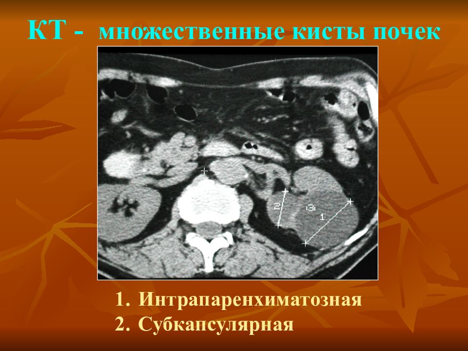 Парапельвикальные кисты почек