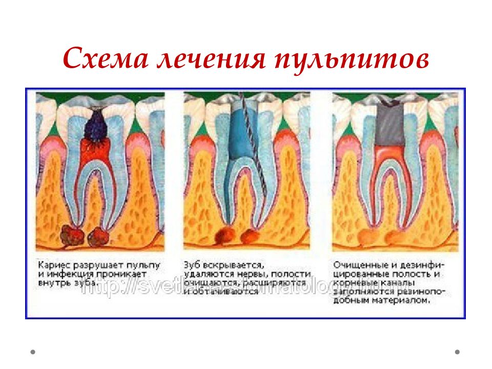 Пульпит лечение. Пульпит периодонтит зубов классификация. Пульпит зуба классификация. Классификация кариес пульпит периодонтит. Классификация пульпитов и периодонтитов.