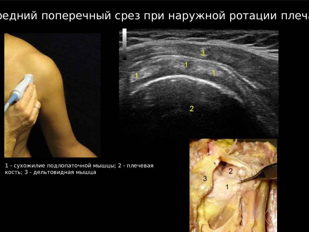 Узи плечевого. УЗИ плечевого сустава норма. Патология плечевого сустава на УЗИ. Ультразвуковая анатомия плечевого сустава. УЗИ суставов плечевого сустава.