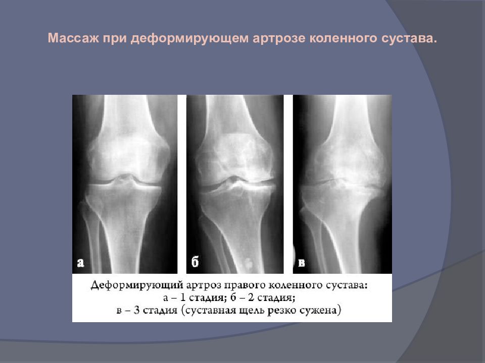 Деформирующий артроз презентация