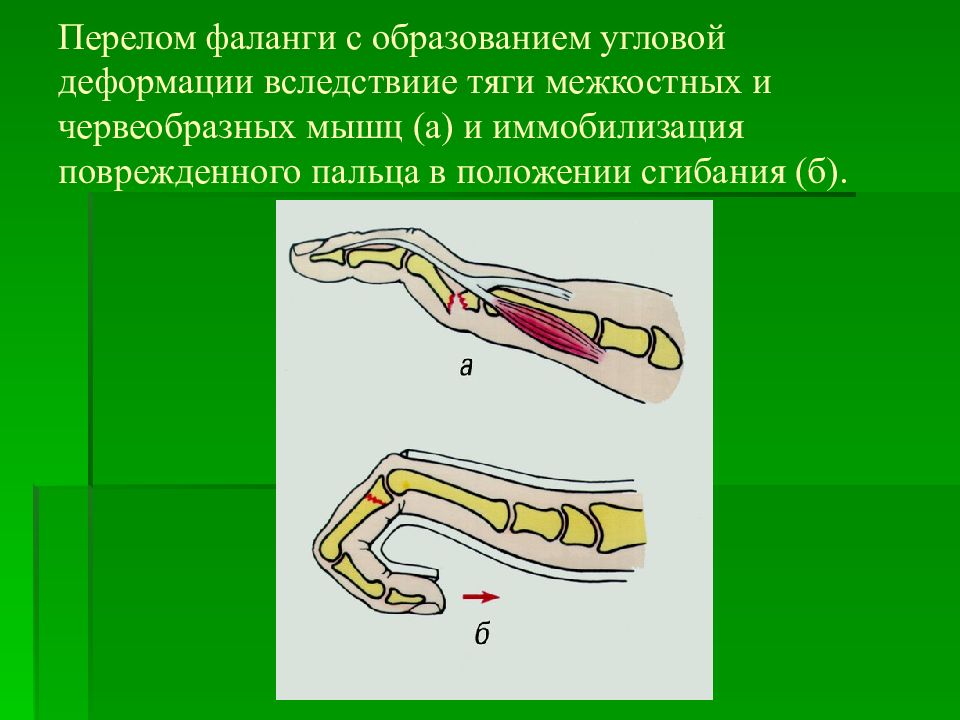 Повреждение кисти травматология презентация