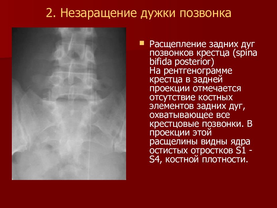 1 рентген. Незаращение дужки l5 позвонка. Незаращение дужки s1 рентген. Незаращение дужки l5 позвонка рентген. Незаращение дужки с1 позвонка.