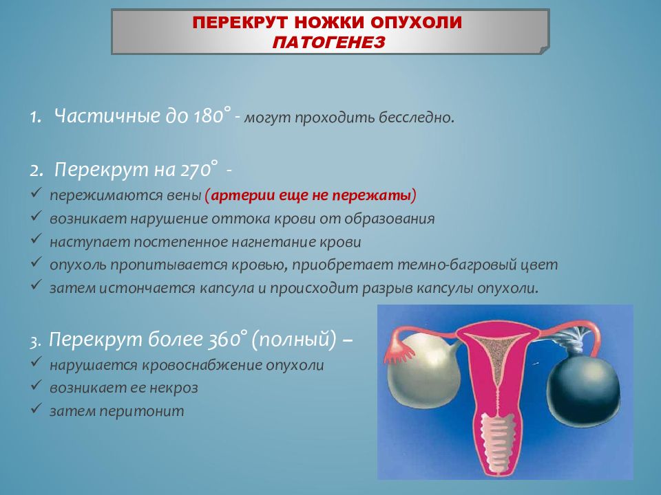Лечение яичника у мужчин. Перекрут кисты яичников. Перекрут ножки кисты яичника. Перекрут кисты яичника классификация. Перекрут ножки опухоли яичника.