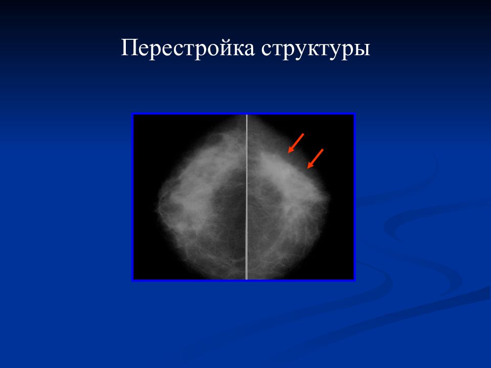 Лучевая диагностика заболеваний молочных желез презентация