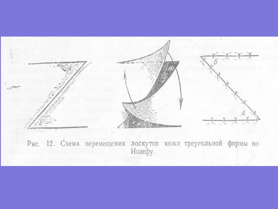 Треугольный лоскут. Пластика встречными треугольными лоскутами по Лимбергу. Треугольные лоскуты по Лимбергу. Кожная пластика встречными треугольными лоскутами по Лимбергу. Метод Лимберга кожная пластика.