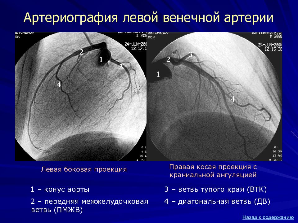 Артериография. Левая боковая проекция Angiography. Боковая проекция правой коронарной артерии. Рентгенологическое исследование венечных артерий. Ангиография восходящей аорты боковая проекция.