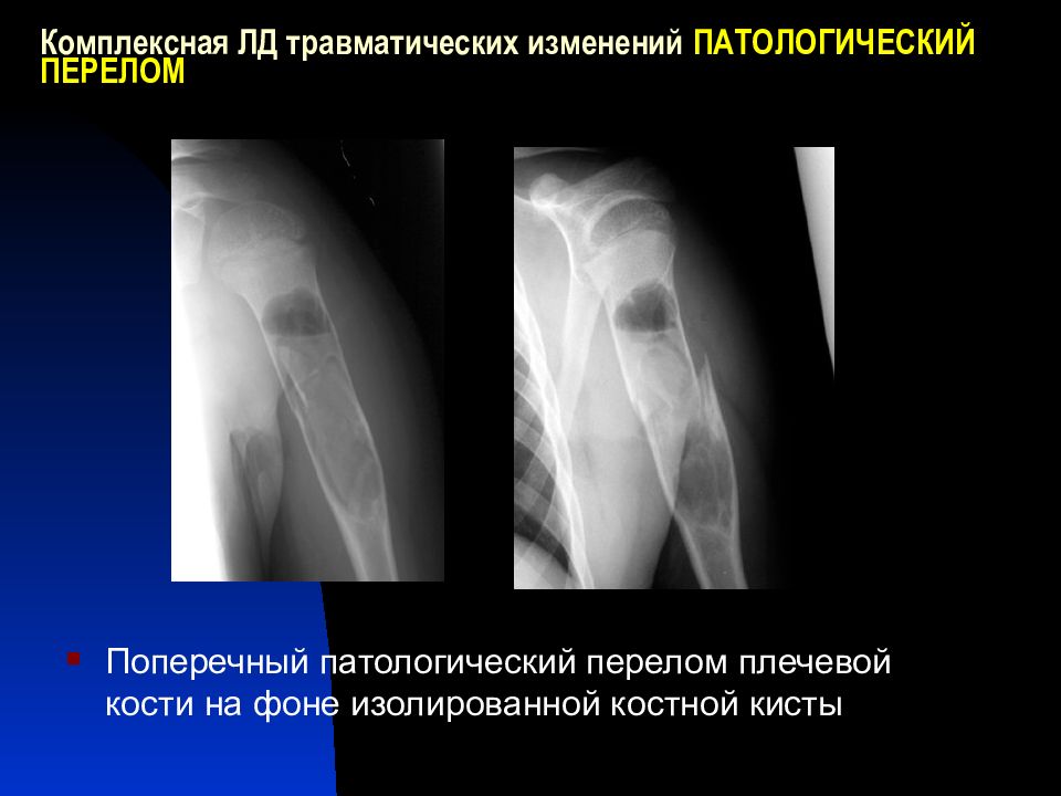 Патологический перелом. Патологический перелом плечевой кости. Патологический перелом кости. Травматические и патологические переломы. Патологический перелом рентген.