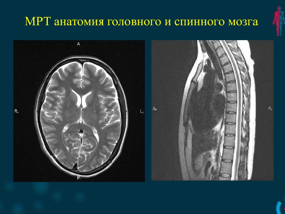МРТ анатомия головного и спинного мозга