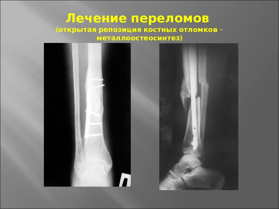 Основы травматологии презентация