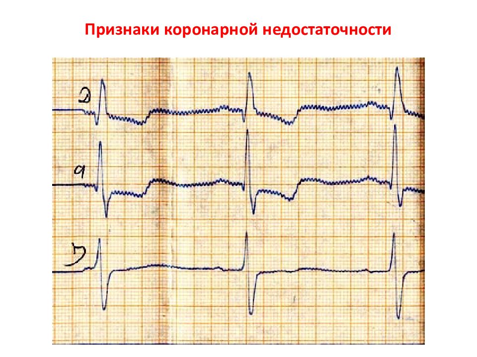 Регистрация сердца. ЭКГ критерии коронарной недостаточности. Ишемия стенокардия на ЭКГ. ЭКГ при хронической ишемической болезни сердца. Коронарная недостаточность на ЭКГ.