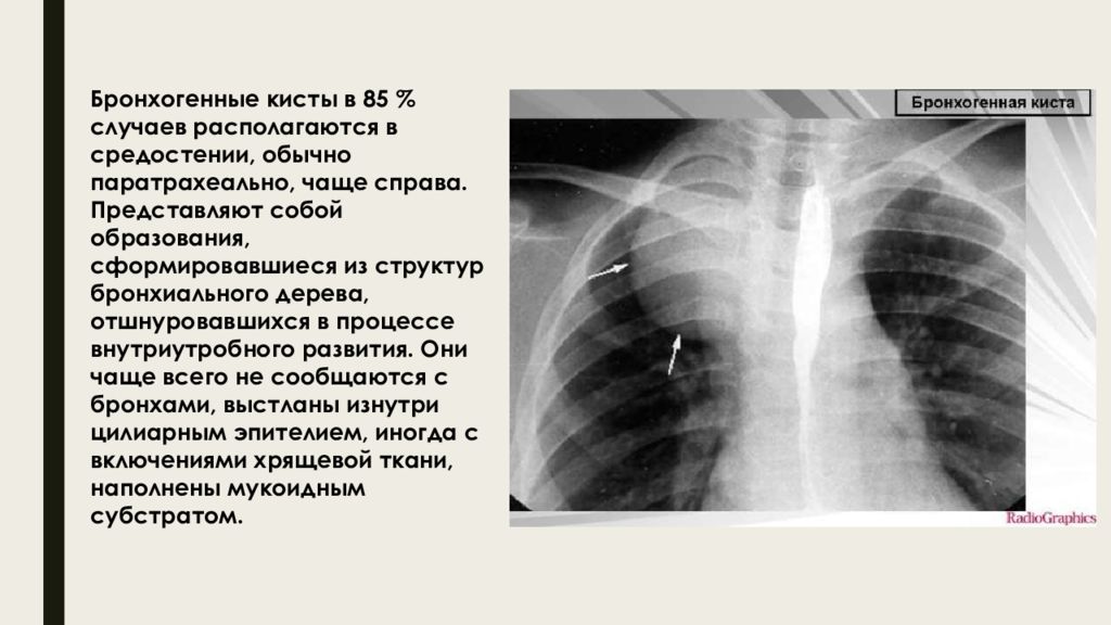 Врожденные пороки развития дыхательной системы презентация