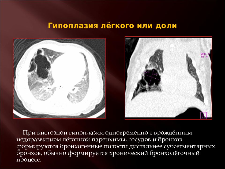 Пороки развития легких презентация