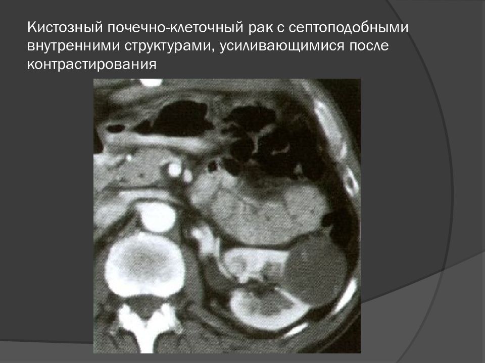 киста накапливающая контраст. кольцевидное накопление контраста при мрт головного мозга. энтерогенная киста средостения на кт. обызвествленная киста печени кт. опухоль тела и хвоста поджелудочной железы.