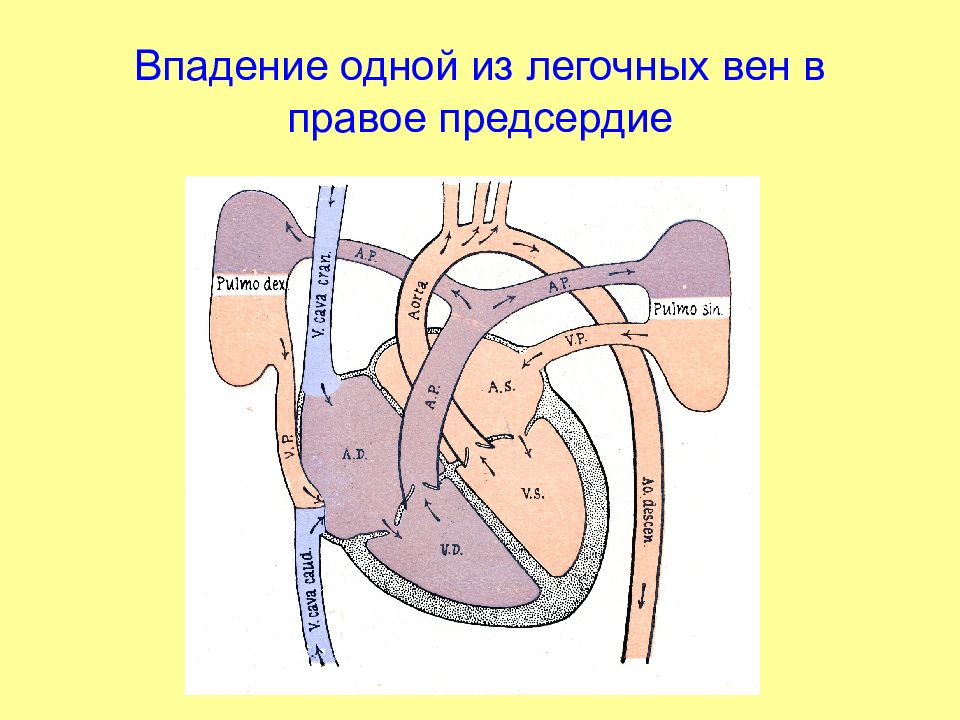 Легочных вен левое предсердие. Аномалии впадения легочных вен. Тотальный аномальный дренаж легочных вен классификация. Тотальный аномальный дренаж легочных вен у новорожденных.