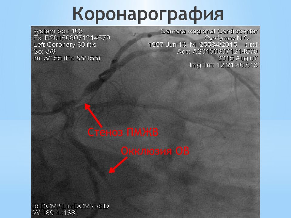 Окклюзия пка. Коронарография стеноз ПМЖВ. Коронароангиография ПМЖВ. Коронароангиография стеноз ПМЖА.