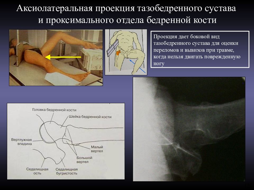 Повреждение тазобедренного сустава презентация