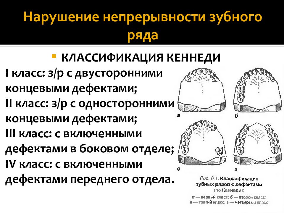 Дефекты зубных рядов