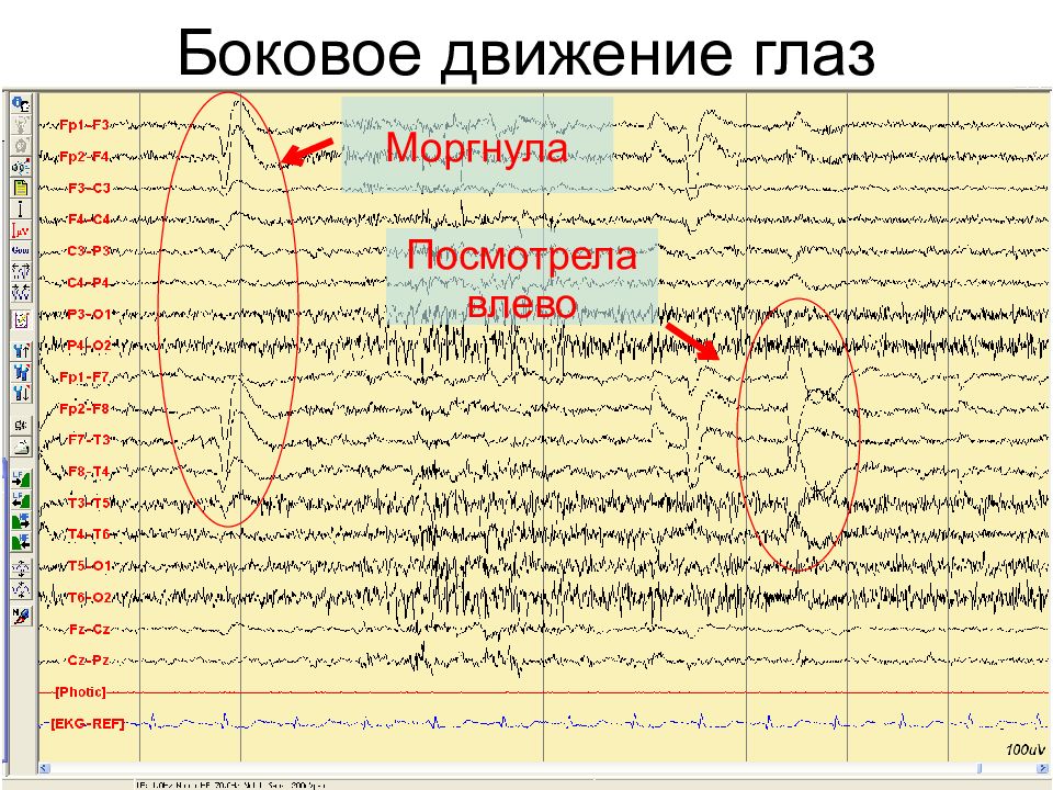 Нарисовать схему стадий сна по данным ээг