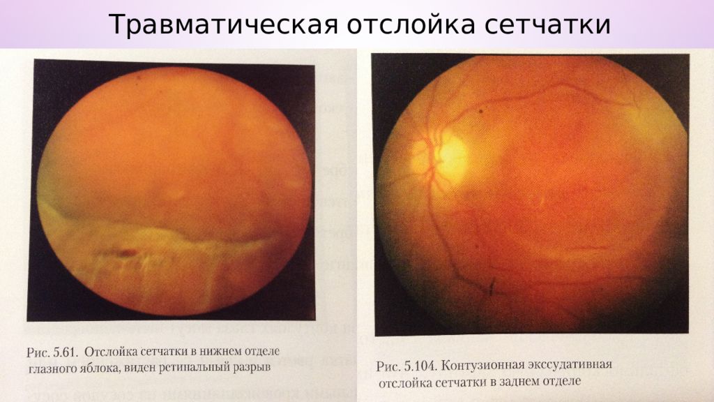 Презентация на тему отслойка сетчатки