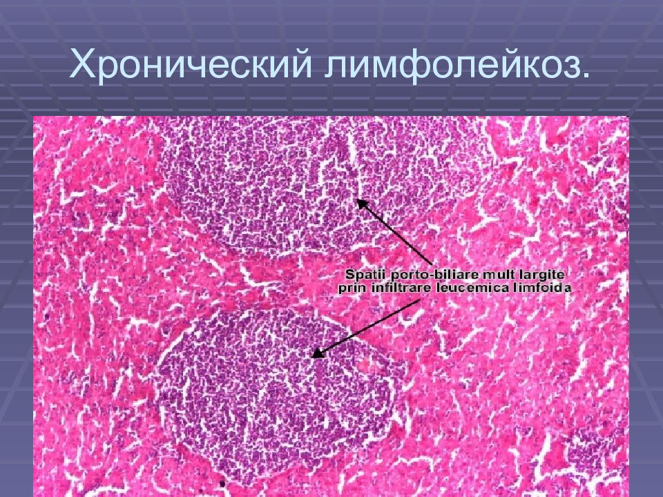 Гемобластозы патологическая анатомия презентация