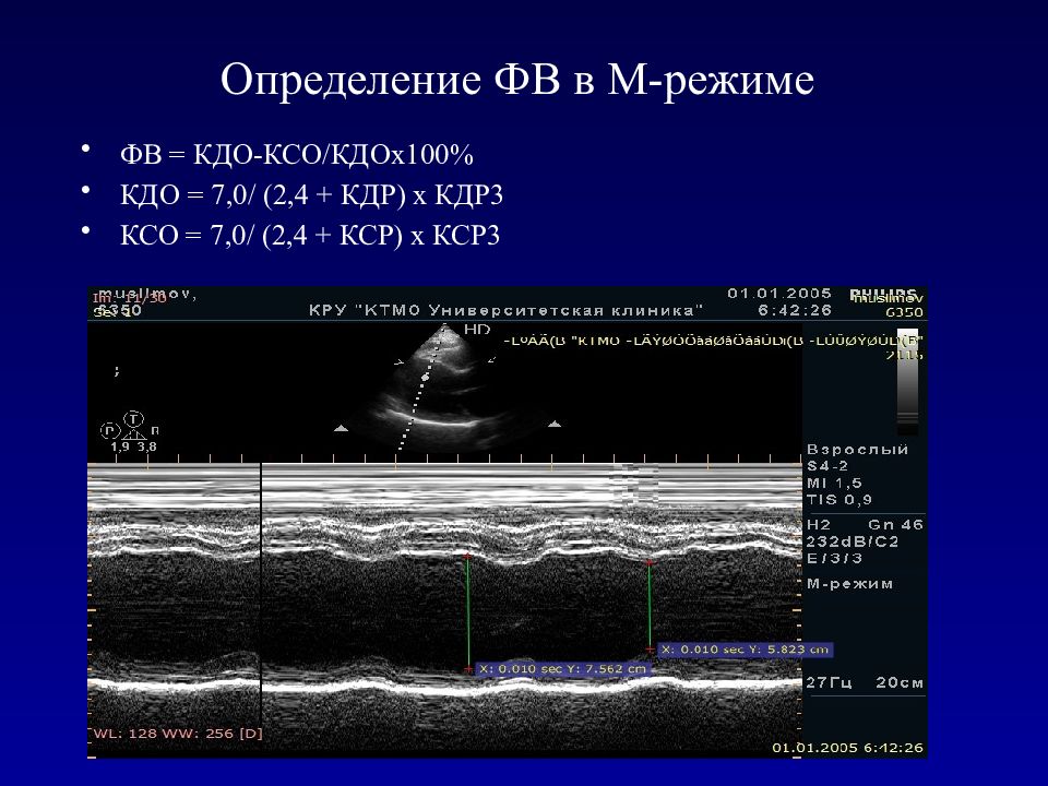 М режим. УЗИ сердца эхокардиография м режим. Измерения в м режиме эхокардиографии. М режим и в режим Эхо кг. Измерение фракции выброса по тейхольцу.