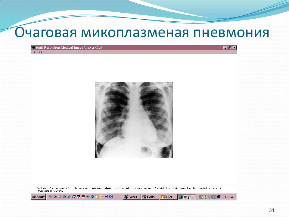 Пневмония презентация вкр