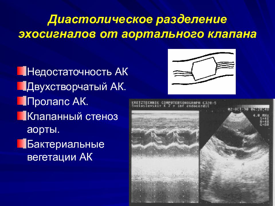 Вегетации на аортальном клапане. Двухстворчатый аортальный клапан. Дистальное затухание эхосигнала.