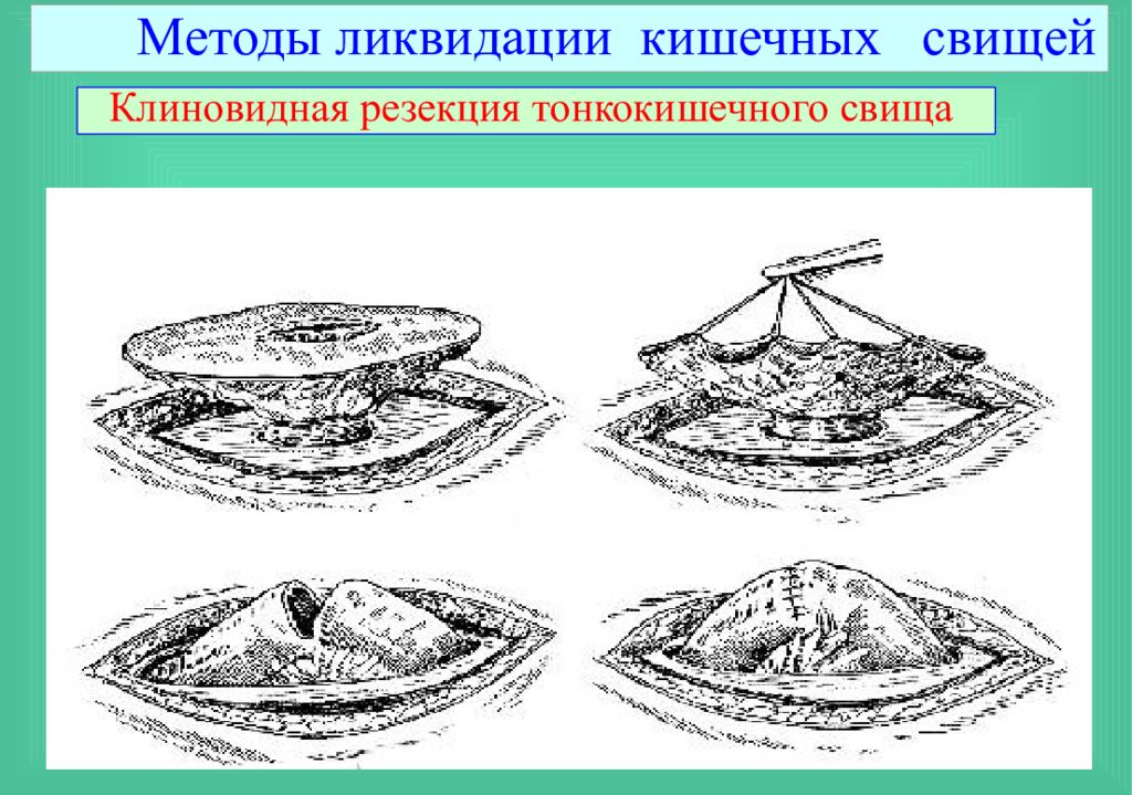 Тонкокишечный свищ. Кишечные свищи Госпитальная хирургия.