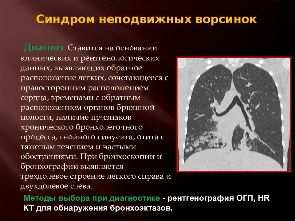 Заболевание аномалия. Пороки развития органов грудной клетки. Обратное расположение легких. Пороки развития органов грудной клетки и лёгких. Пороки развития органов грудной клетки детская хирургия презентация.