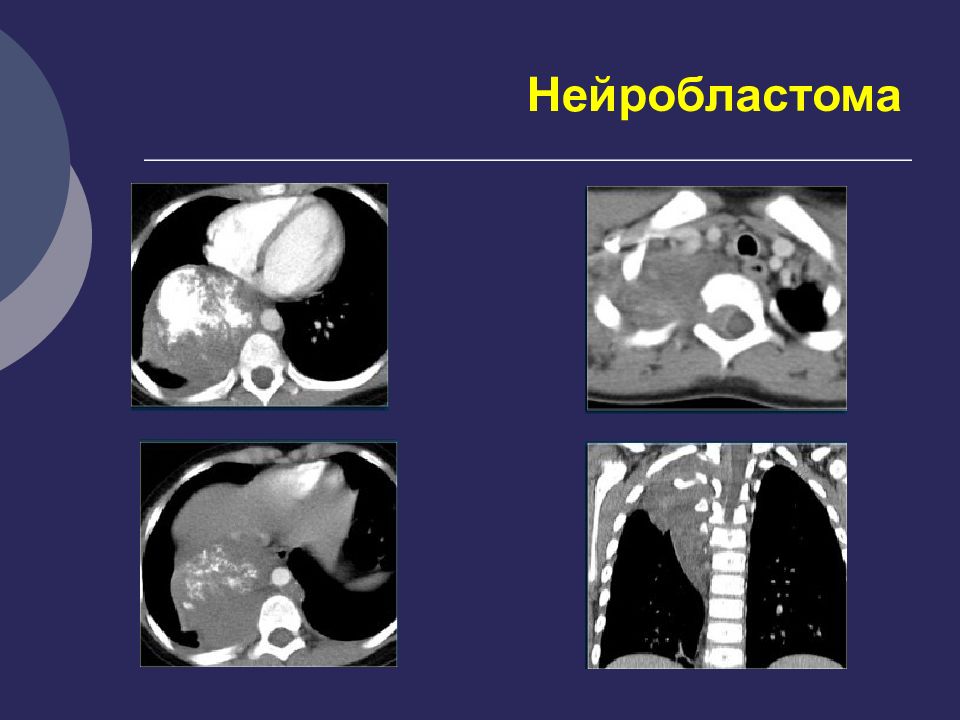 Нейробластомы у детей презентация