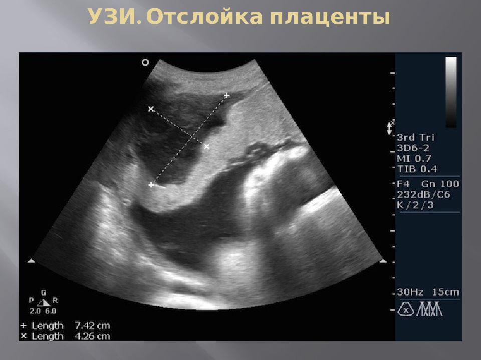 13 неделе беременности плацента. Ретрохориальная гематома снимок УЗИ. Преждевременная отслойка нормально расположенной плаценты УЗИ. Преждевременная отслойка плаценты УЗИ.