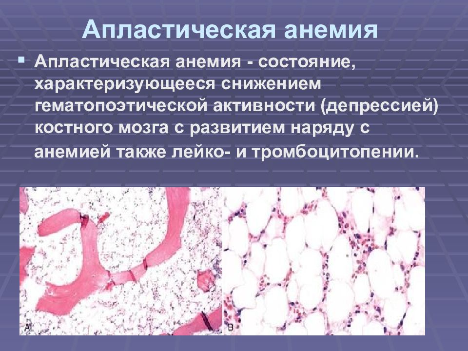 Апластическая анемия клиническая картина