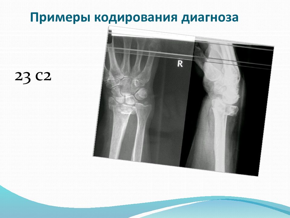 Перелом дистального метаэпифиза лучевой кости. Перелом дистального метаэпифиза лучевой кости рентген. Краевой перелом дистального эпифиза лучевой кости. Закрытый оскольчатый перелом дистального метаэпифиза лучевой кости. Поперечный перелом метаэпифиза лучевой кости.