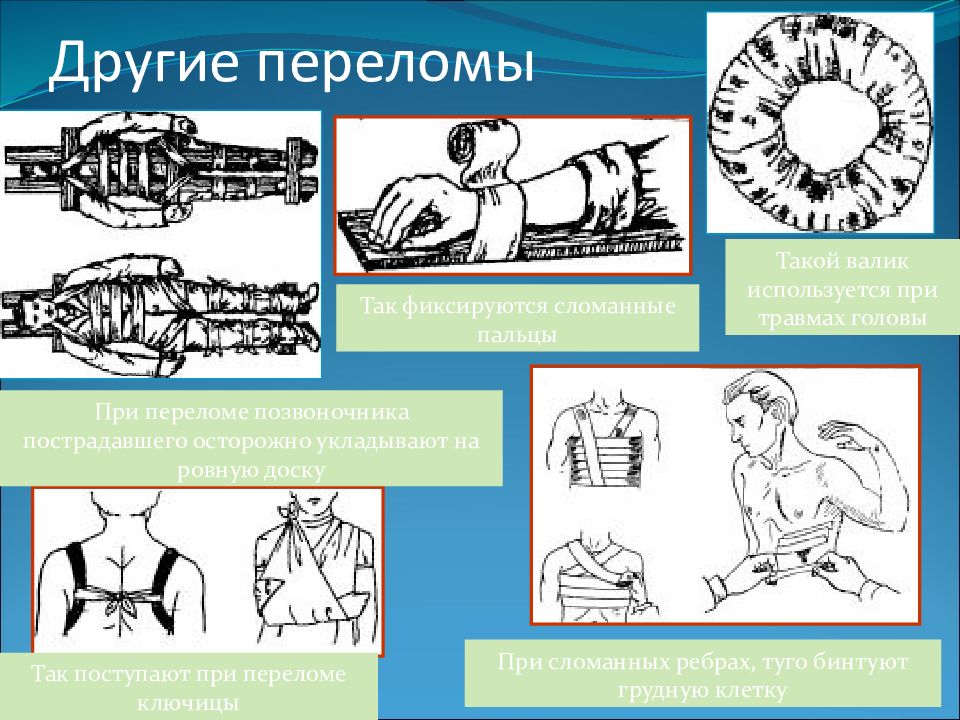 Первая помощь при ушибах и переломах