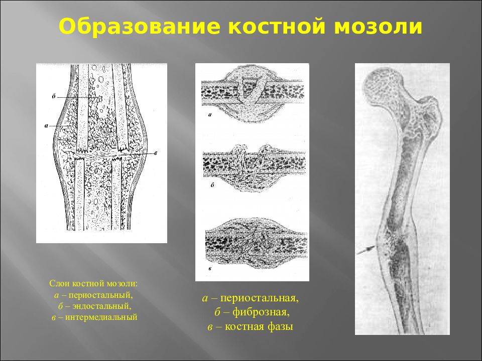 Костная мозоль у детей. Параоссальная костная мозоль. Периоссальная костная мозоль рентген. Этапы формирования костной мозоли. Интермедиарная костная мозоль.