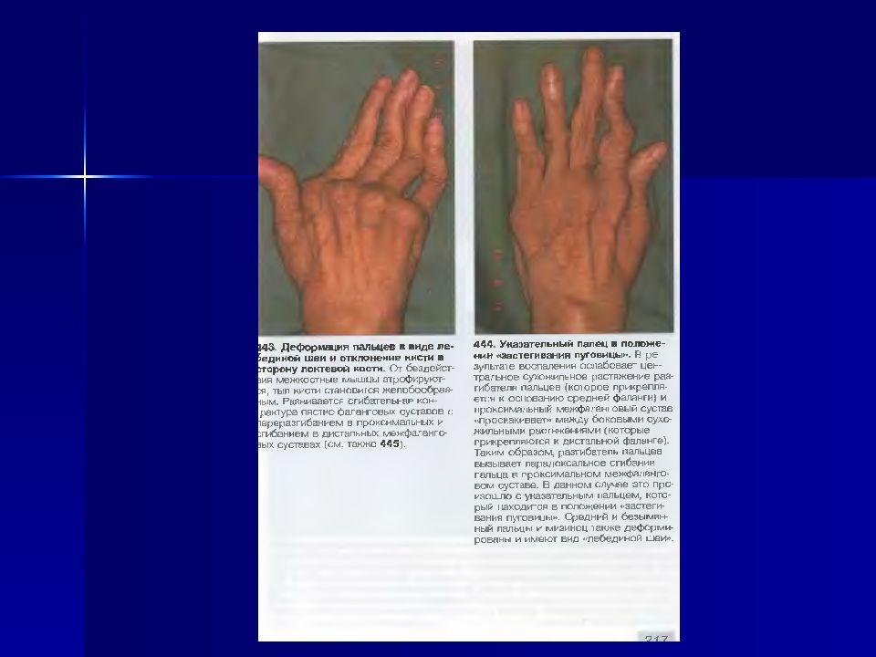 Ревматоидный артрит кисти рентген. Артрит инвалидность какой. Артрит инвалидность какой. Артрит инвалидность какой. 1 группа инвалидности при ревматоидном артрите.