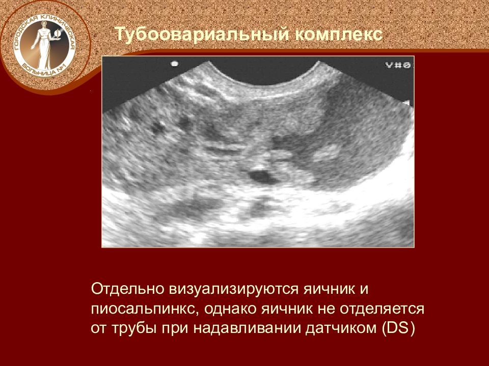 Что значит яичники не визуализируются на узи. Тубоовариальный абсцесс УЗИ. Тубоовариальное образование на УЗИ. Пиосальпинкс и тубоовариальный абсцесс. Тубоовариальное образование яичника.